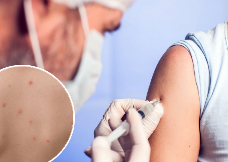 U Britaniji zbog epidemije ospica krenula kampanja za cijepljenje